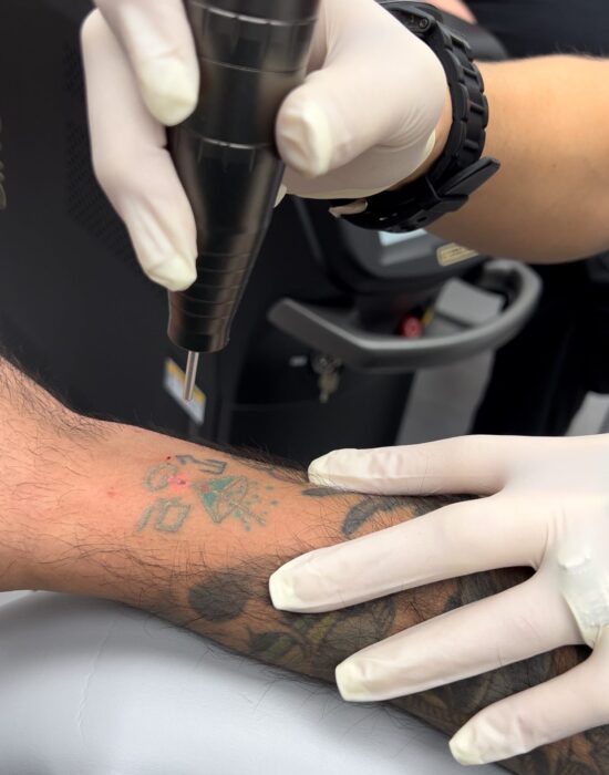 LaserTattooRemoval