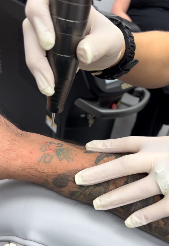 LaserTattooRemoval