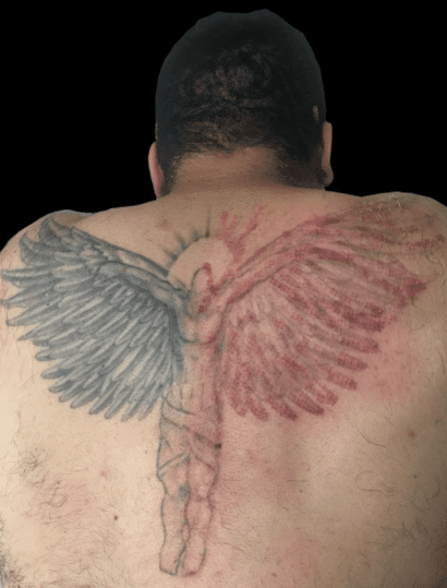 TattooRemoveBefore